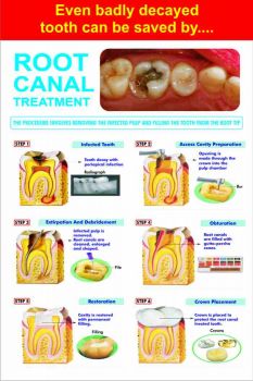Root Canal Treatment - Dental Poster