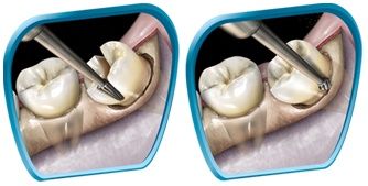 SS White Oral Surgery Burs - Series
